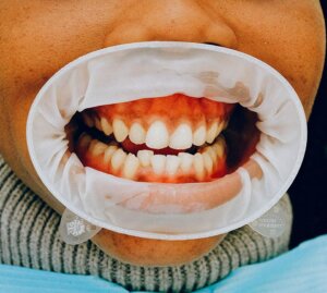 eksperci przestrzegają nie wolno ignorować zgrzytania zębami
