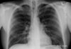 rak płuca leczenie międzyrzecz 000