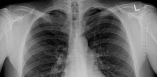 rak płuca leczenie międzyrzecz 000