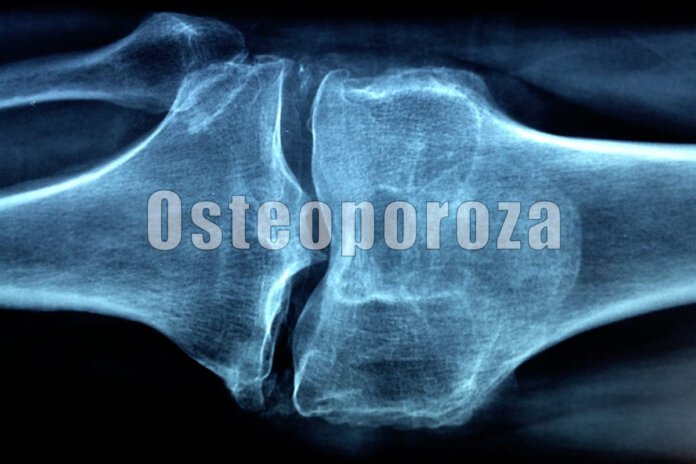 osteoporoza 000